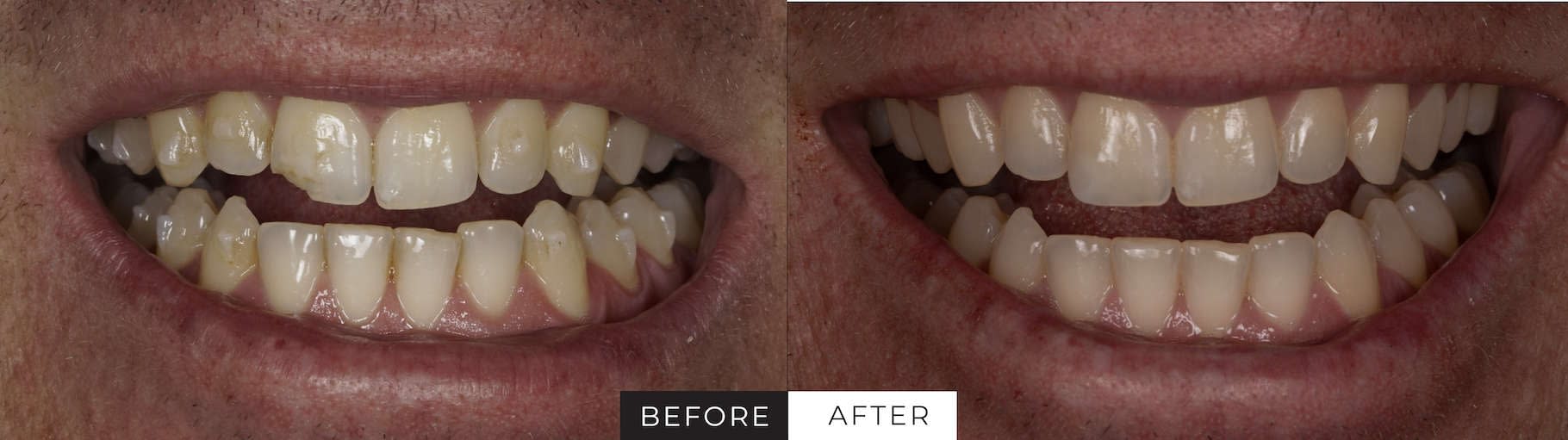 Cosmetic Dentistry Las Vegas Composite Resin JB White DDS