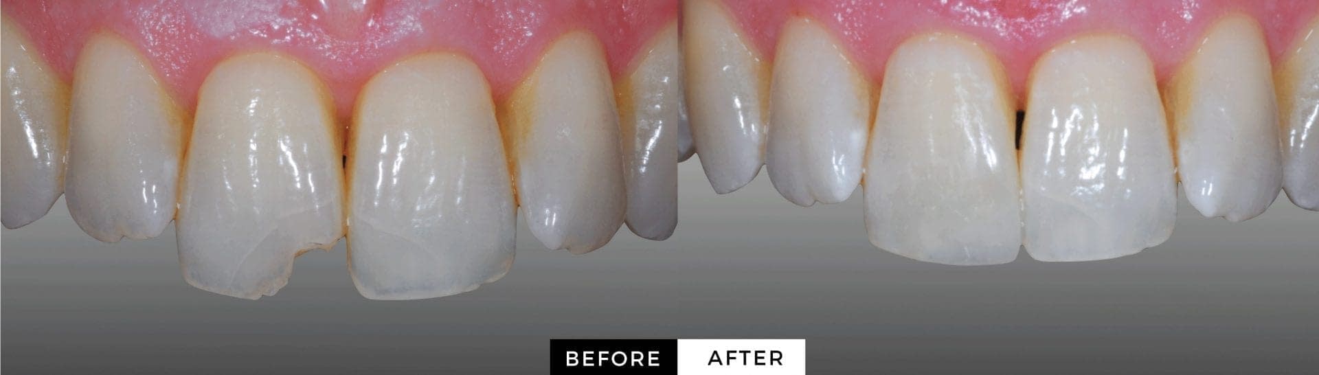 Cosmetic Dentistry Las Vegas Composite Resin JB White DDS