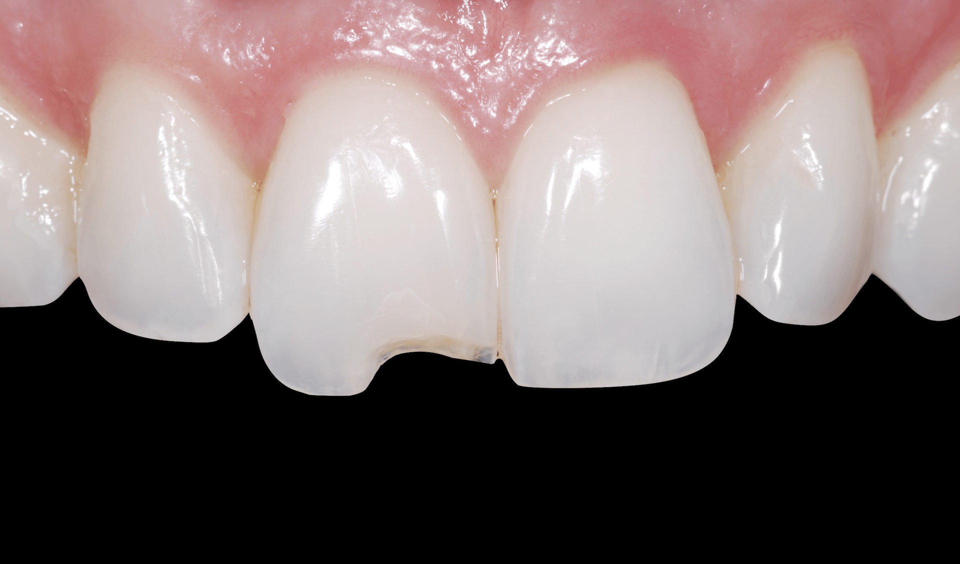 Cosmetic Dentistry Las Vegas Composite Resin JB White DDS