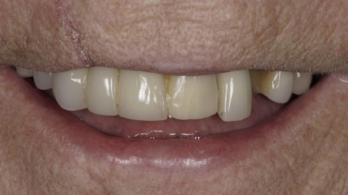 Dental Implants Las Vegas, NV JB White DDS