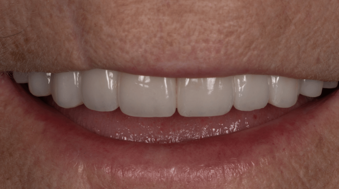 Dental Implants Las Vegas, NV JB White DDS