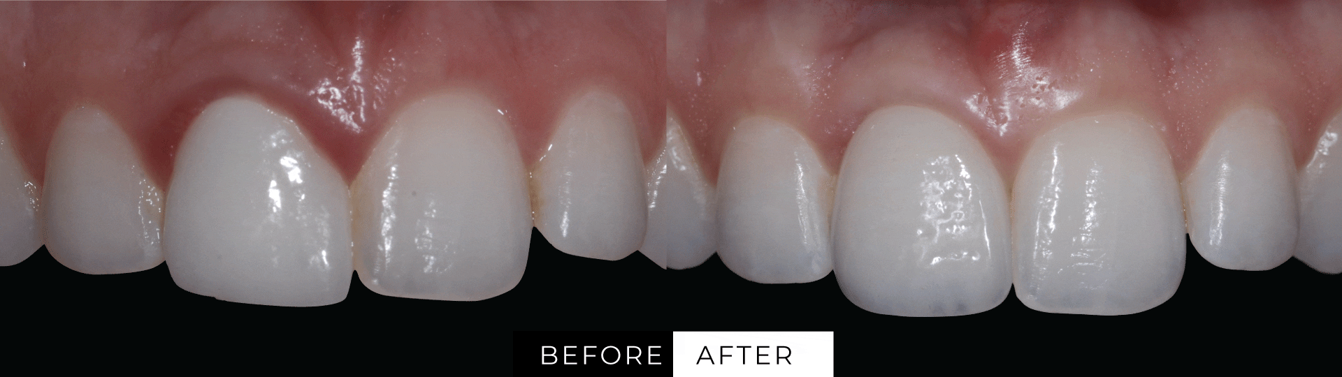 Dental Implants Las Vegas, NV JB White DDS