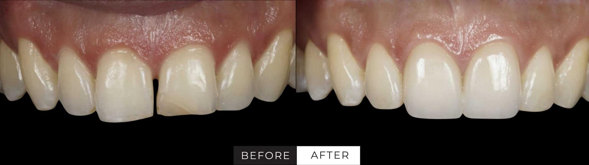 Veneers Las Vegas Porcelain Veneers JB White DDS