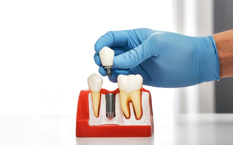 am i the right fit for dental implants