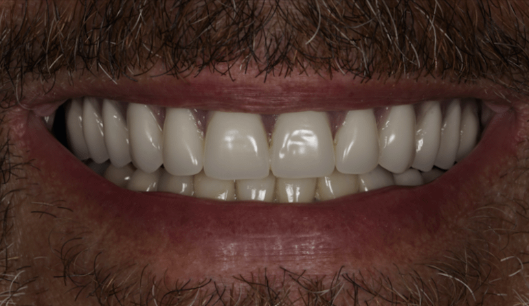 Dental Implant After