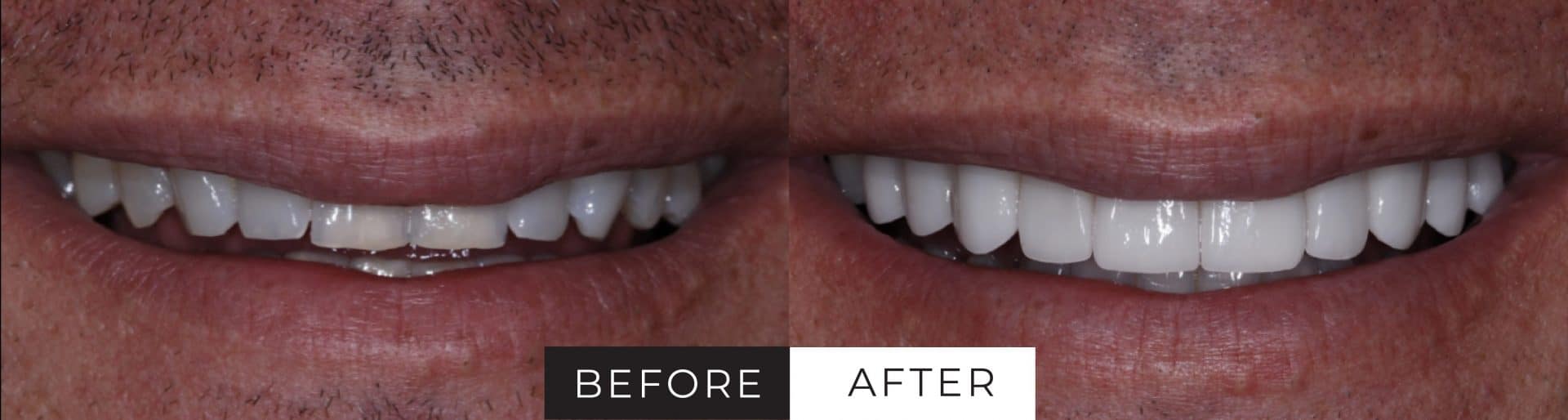 Veneers Las Vegas Porcelain Veneers JB White DDS